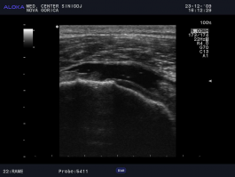 Ultrazvok rame - utrgana tetiva supraspinatusa 2